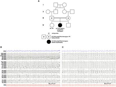 A novel pathogenic SLC12A5 missense variant in epilepsy of infancy with migrating focal seizures causes impaired KCC2 chloride extrusion