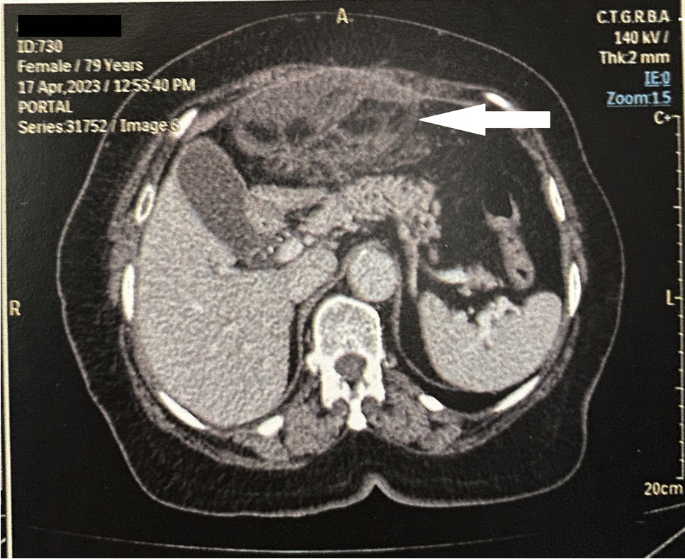 Infarction of the Greater Omentum Presenting as Acute Pancreatitis