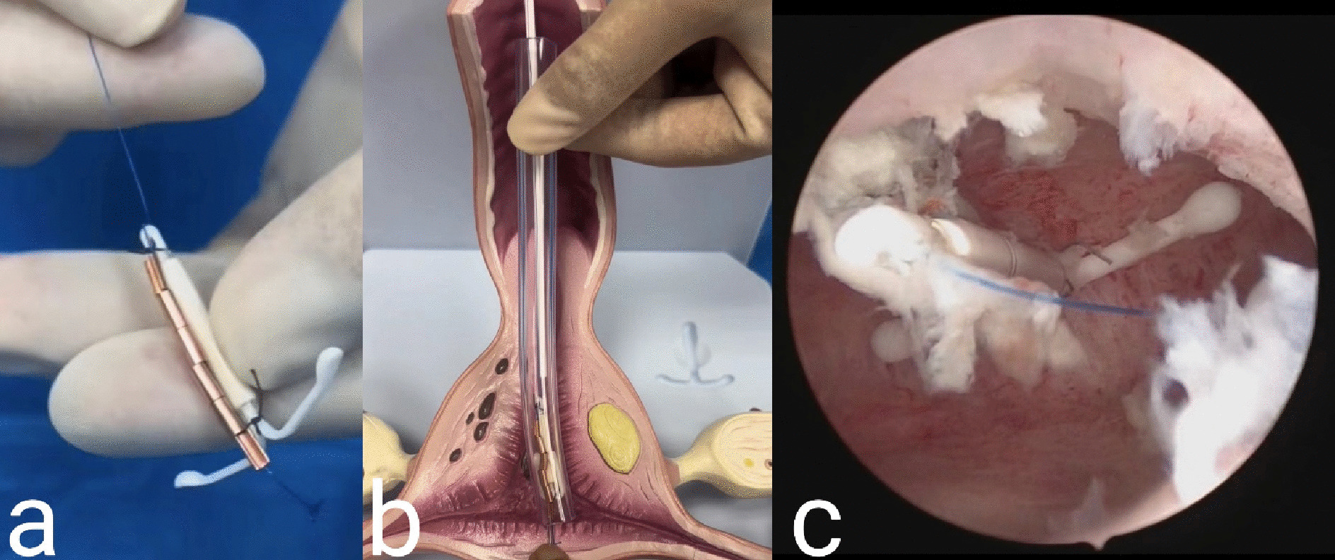 Simple and Novel Technique of Fixation for Levonorgestrel-Releasing Intrauterine Device for the Treatment of Uterine Adenomyosis