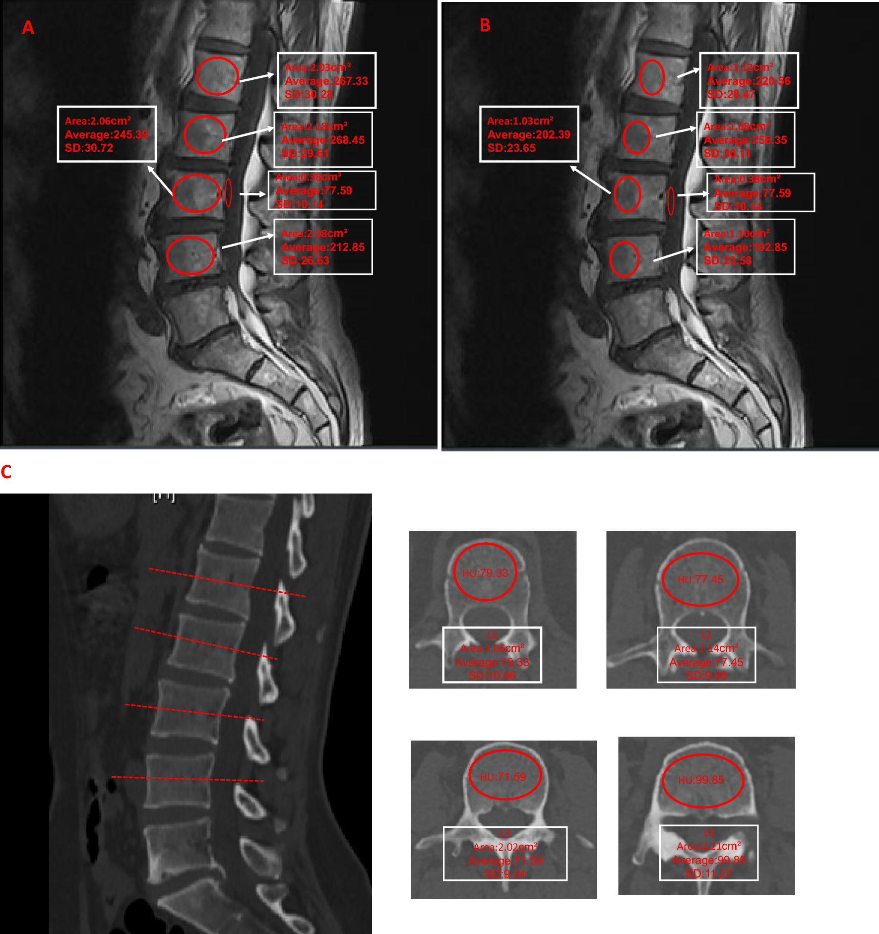 Evaluation of the modified MRI vertebral bone quality score for bone quality in lumbar degenerative disorders