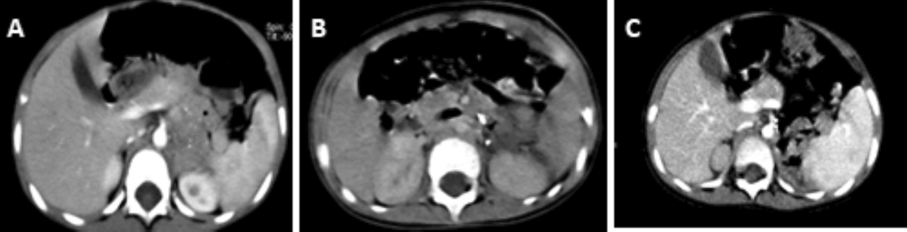 Bilateral adrenal neuroblastoma: peculiar pattern of a rare pediatric presentation