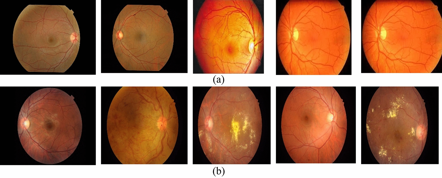 Diagnosis of retinal damage using Resnet rescaling and support vector machine (Resnet-RS-SVM): a case study from an Indian hospital