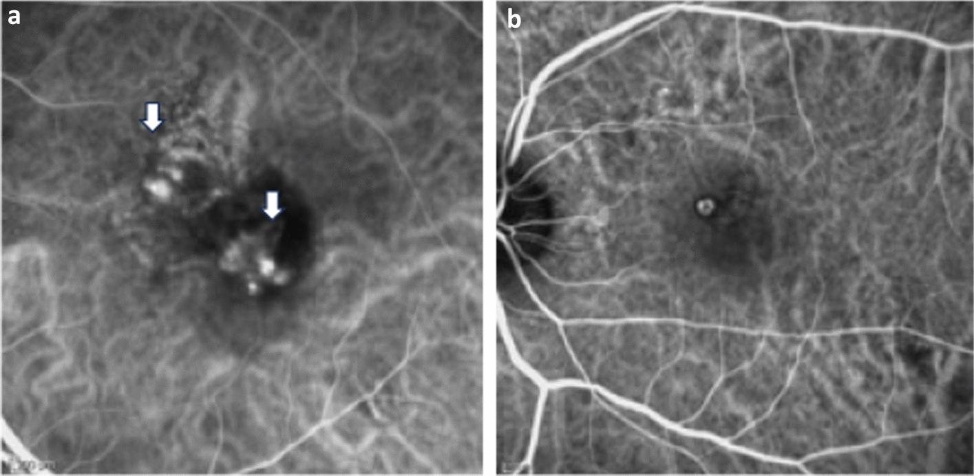 Association between the arm-to-choroidal circulation time and clinical profile in patients with polypoidal choroidal vasculopathy