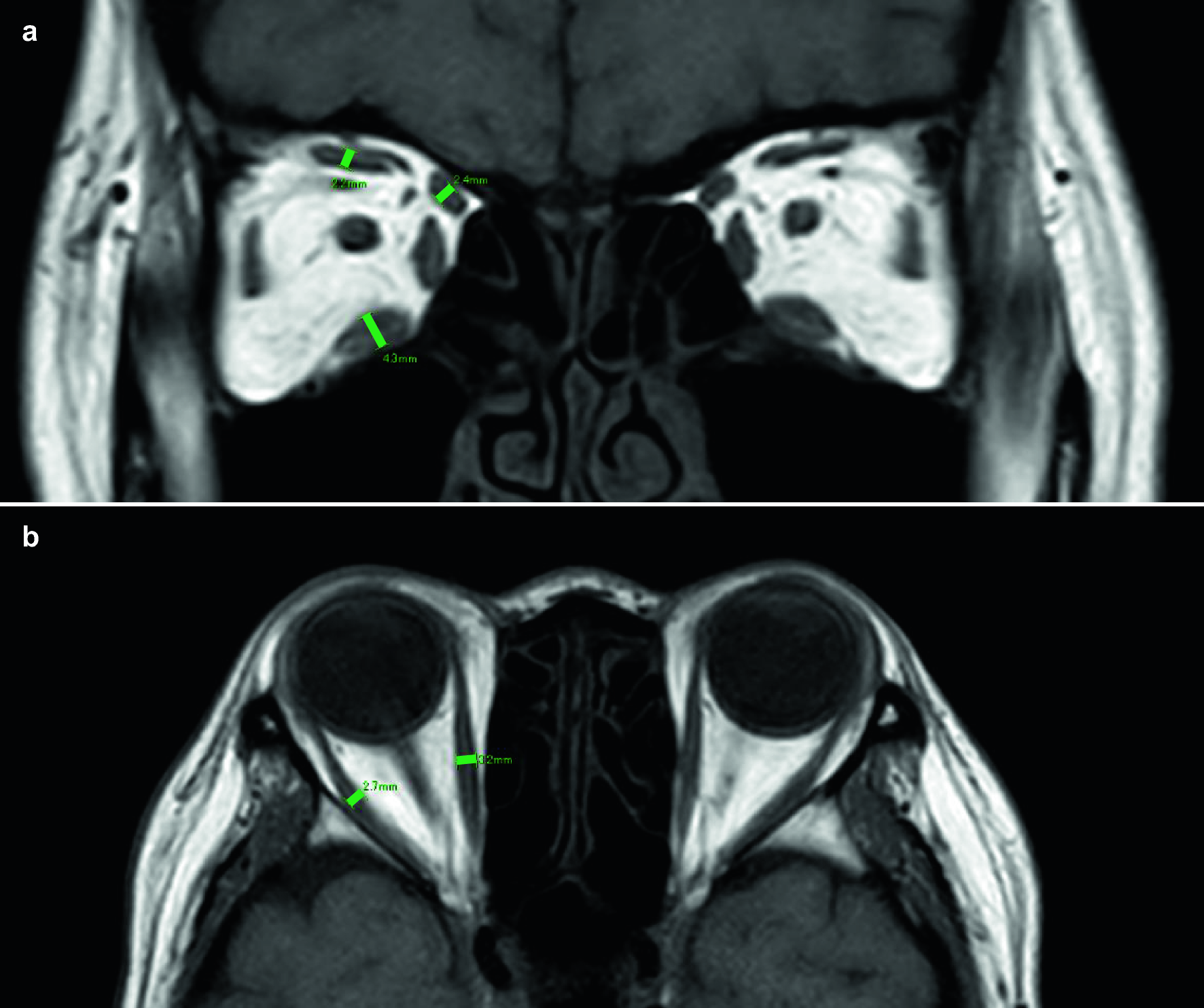Correlation between extraocular muscle enlargement and thyroid autoantibodies in thyroid eye disease