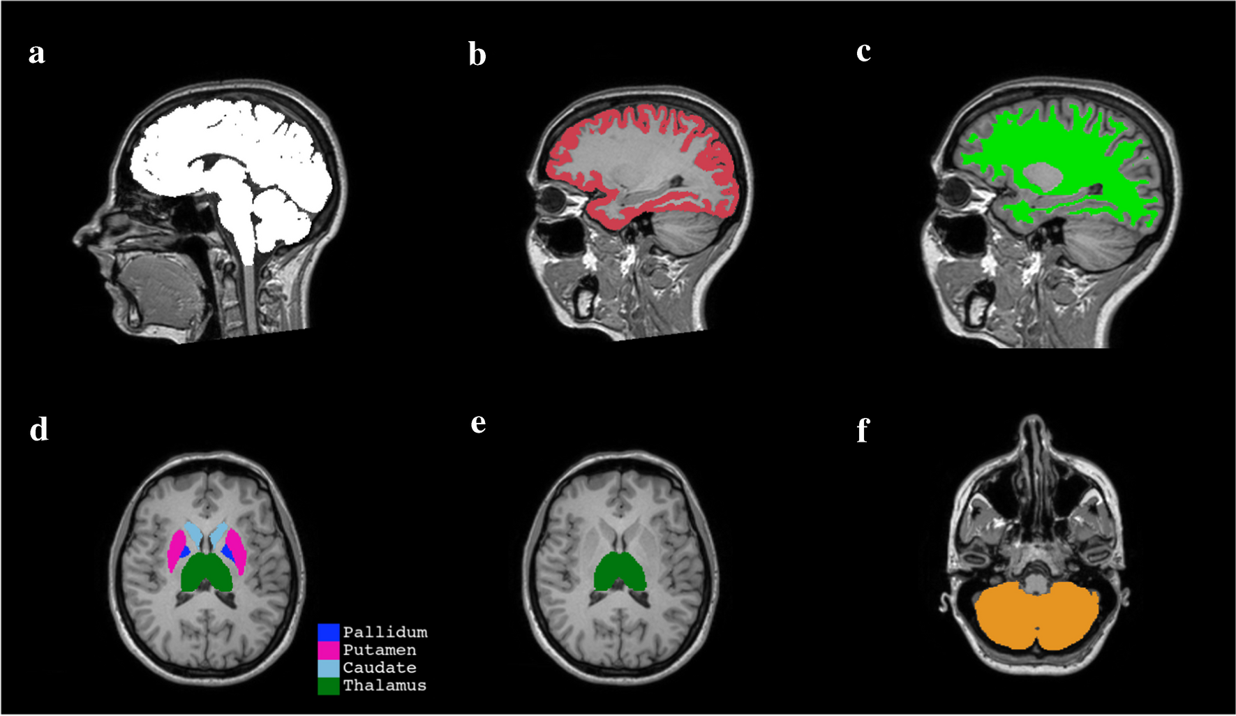 Mapping brain volume change across time in primary-progressive multiple sclerosis