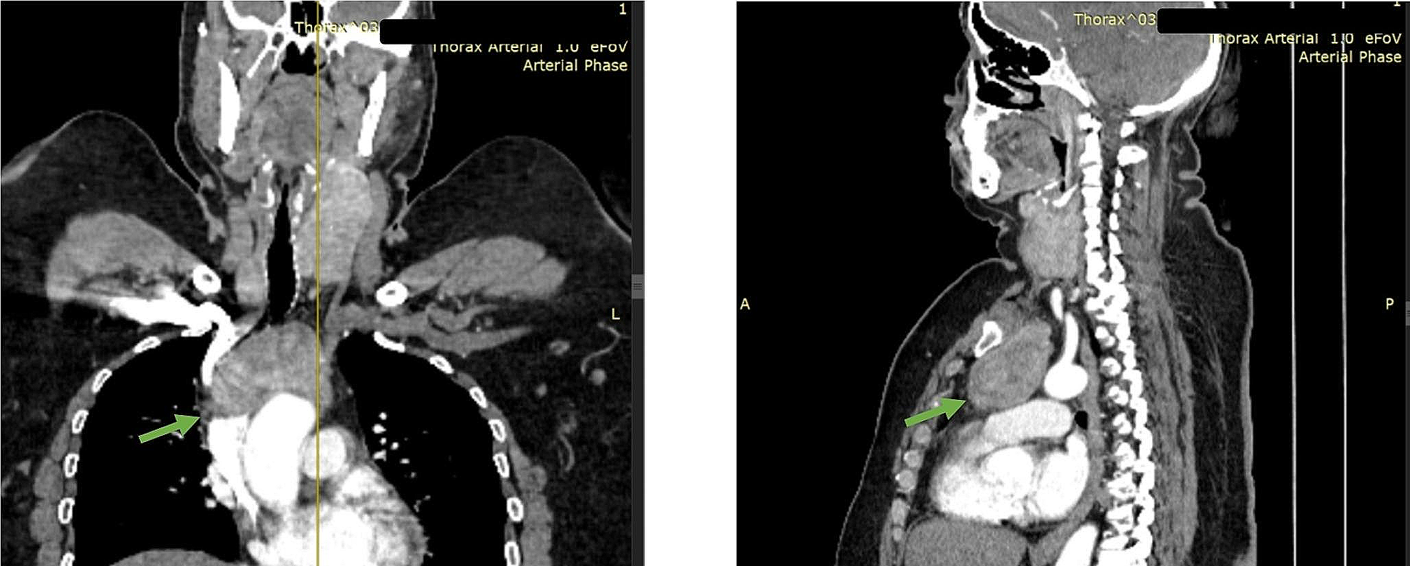 Isolated Mediastinal Goitre: A Case Report