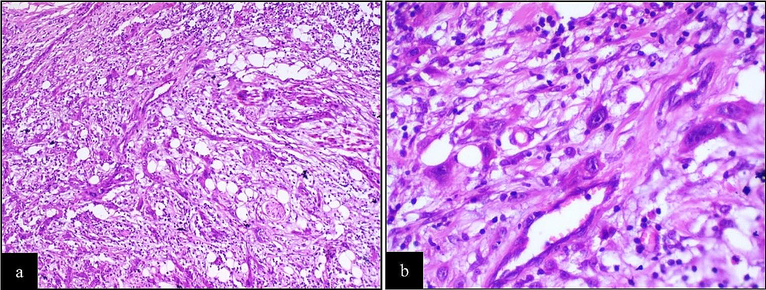 Prognostic Role of Tumor Budding and Worst Pattern of Invasion in Lymph Node Metastasis and Disease-Free Survival in Oral Squamous Cell Cancer Patients: Result from Central India’s Regional Cancer Centre