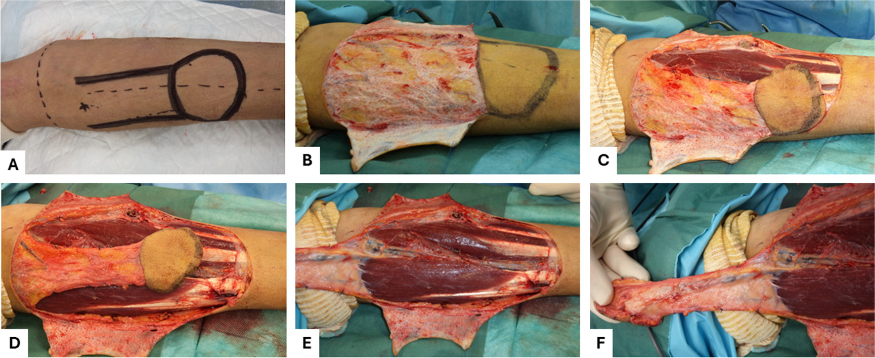 Elbow coverage by the descending superficial radial artery flap: a clinical series and literature review