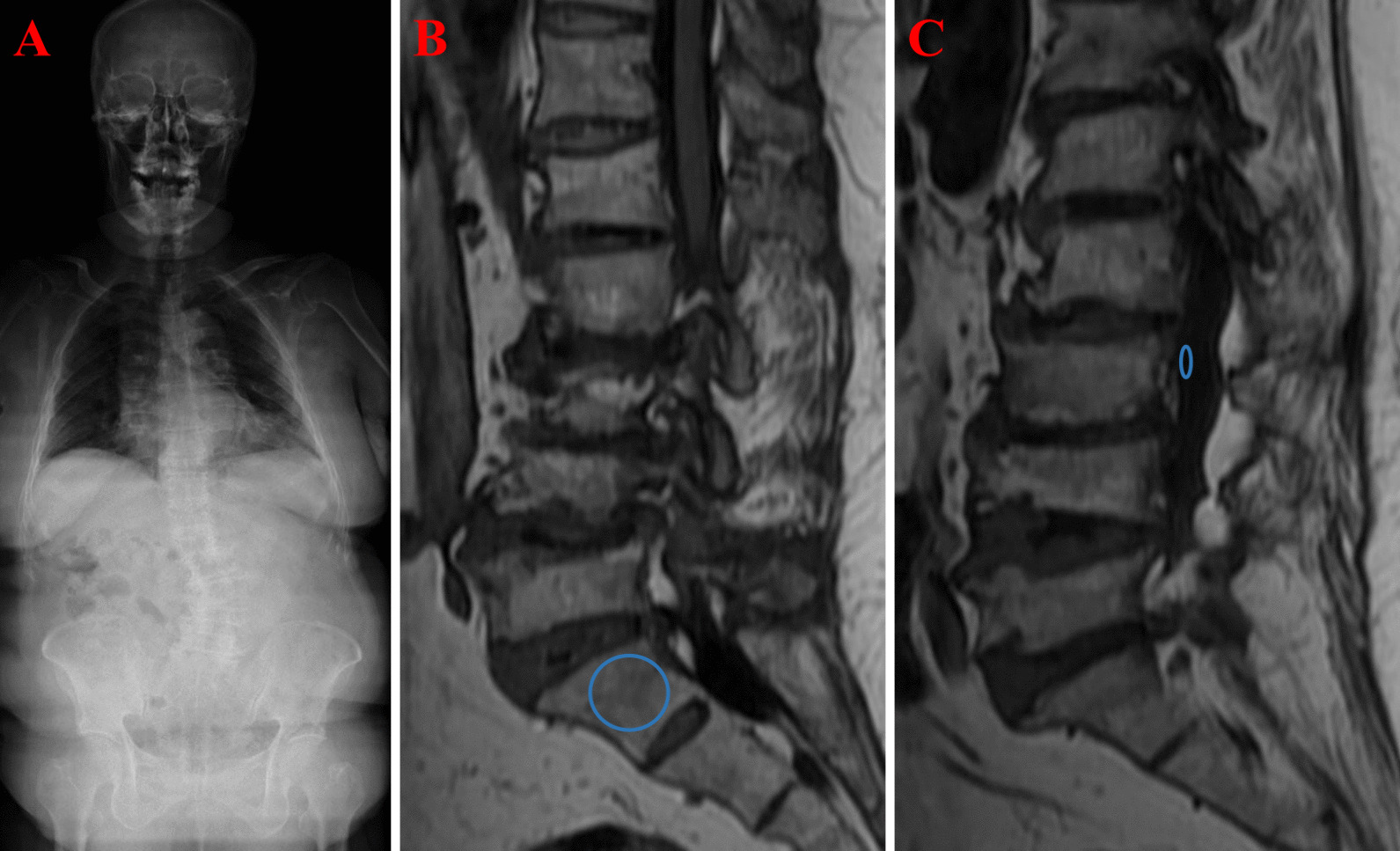 Simplified S1 vertebral bone quality score independently predicts proximal junctional kyphosis after surgery for degenerative lumbar scoliosis