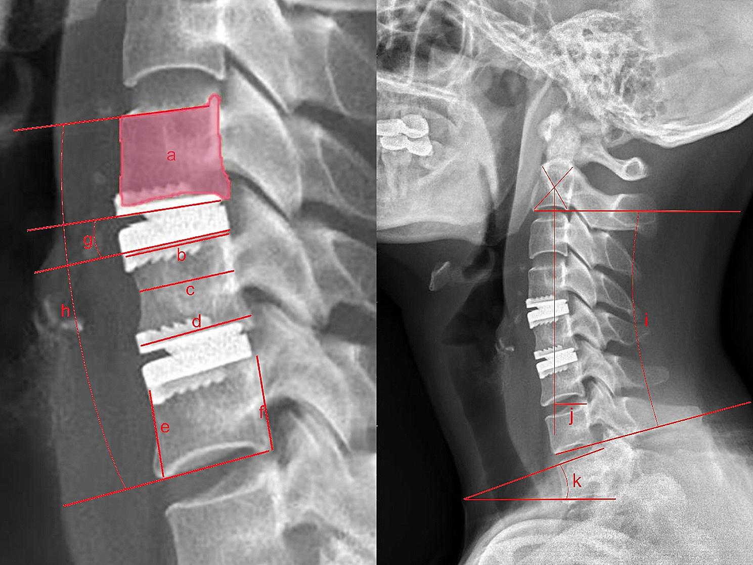 More anterior bone loss in middle vertebra after contiguous two-segment cervical disc arthroplasty