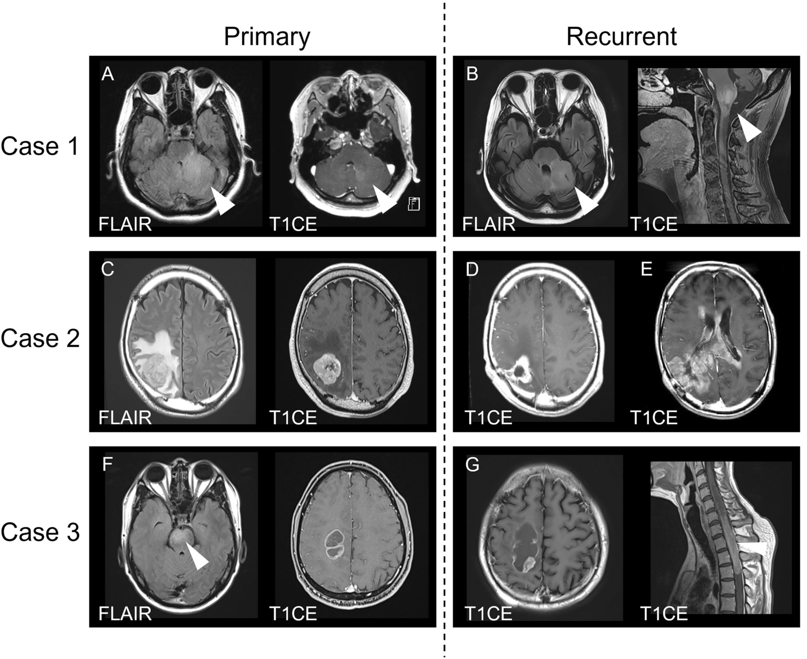 Pediatric-type high-grade gliomas with PDGFRA amplification in adult patients with Li-Fraumeni syndrome: clinical and molecular characterization of three cases