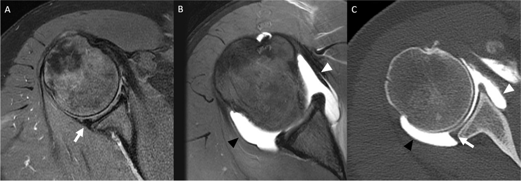 Radiographic and Advanced Imaging Evaluation of Posterior Shoulder Instability