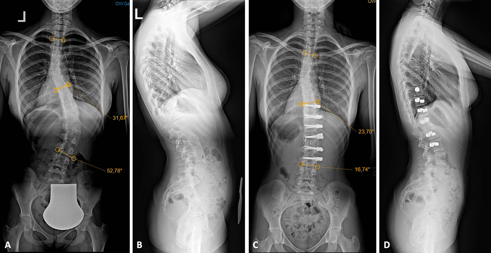 Early-term outcome of apical fusion with vertebral body tethering for thoracolumbar curves in adolescent idiopathic scoliosis: a preliminary study