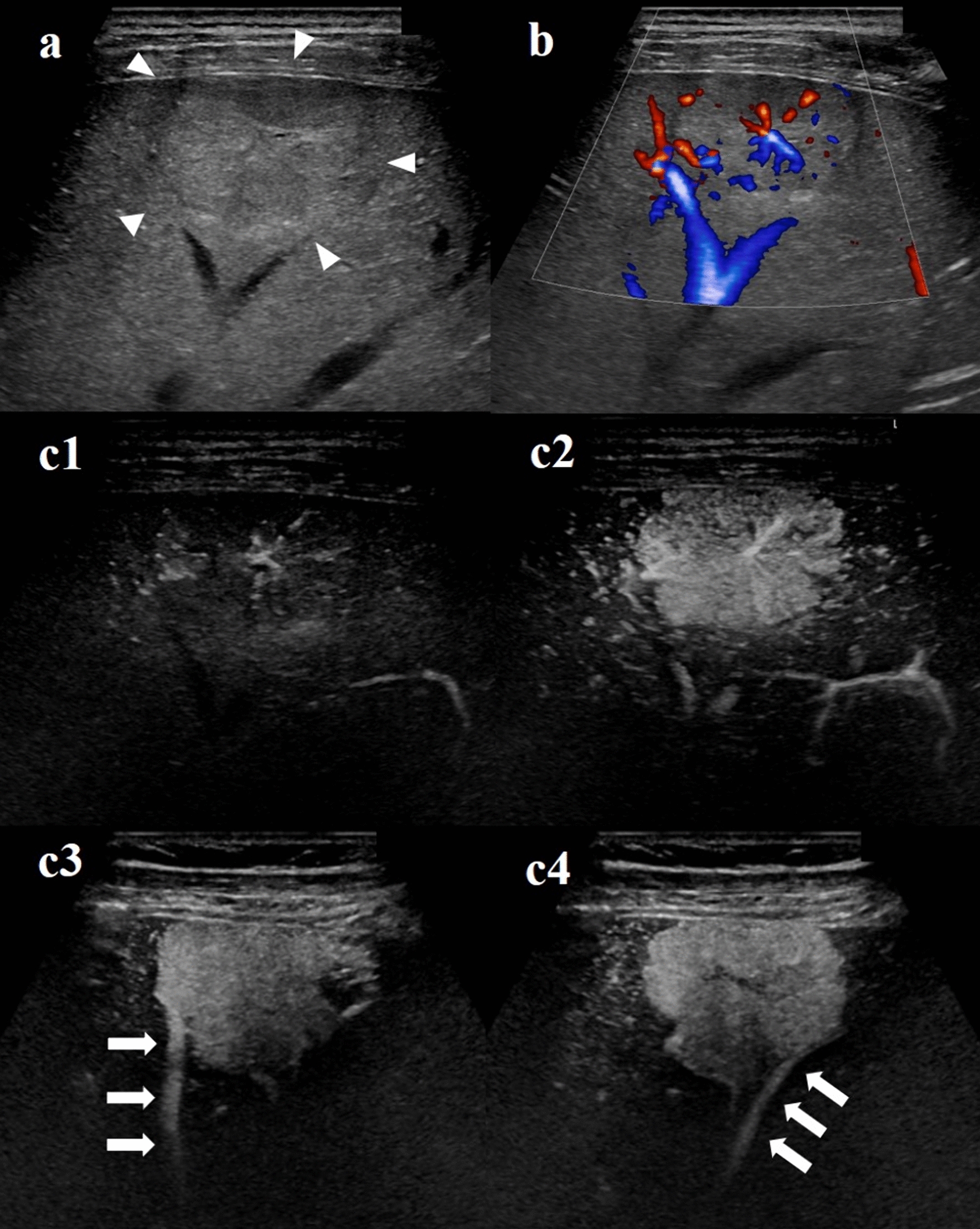 Assessment of drainage vein of focal nodular hyperplasia using contrast-enhanced ultrasound