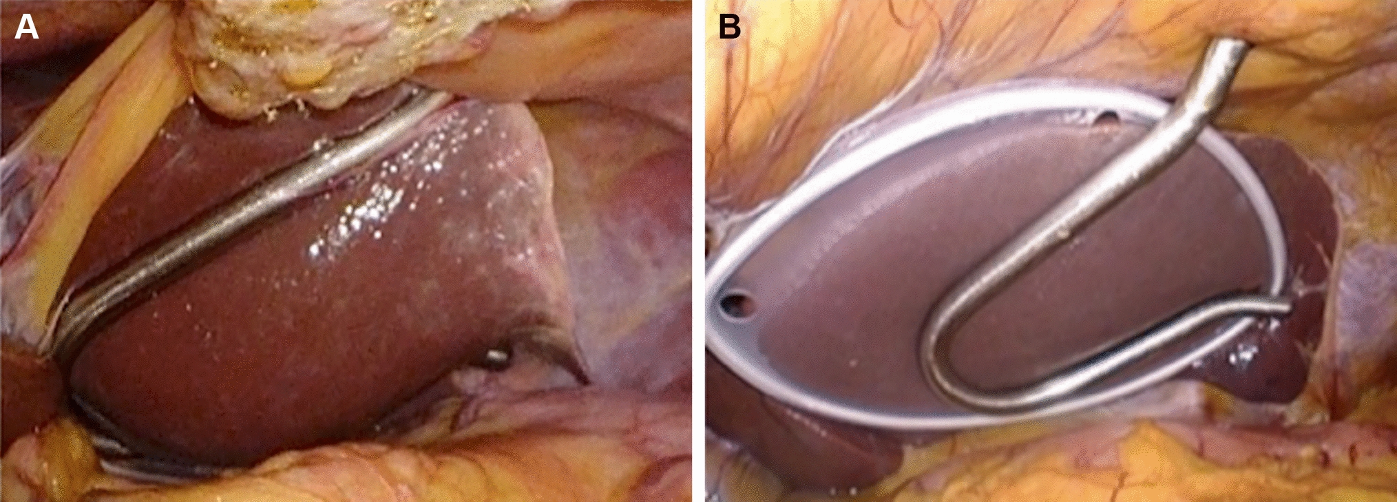 A silicone disc for liver retraction in laparoscopic gastrectomy reduces the postoperative increase in the liver enzyme level