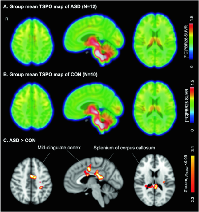 In vivo translocator protein in females with autism spectrum disorder: a pilot study
