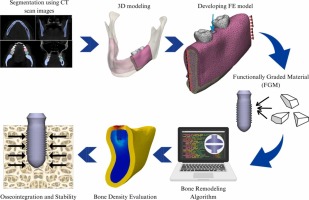 Evaluating the effect of functionally graded materials on bone remodeling around dental implants