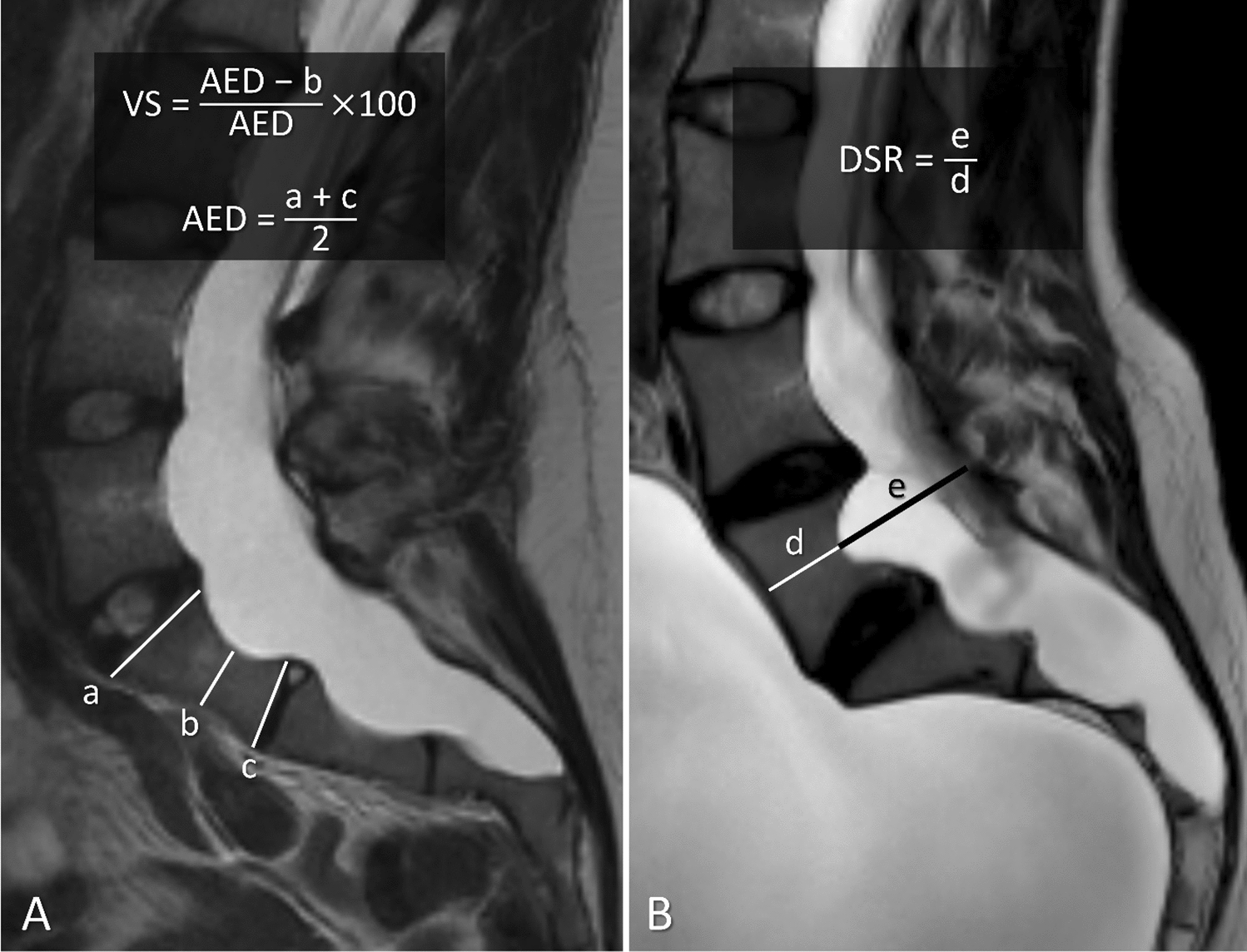 Quantitative measurement of dural ectasia: associations with clinical and genetic characteristics in Marfan syndrome