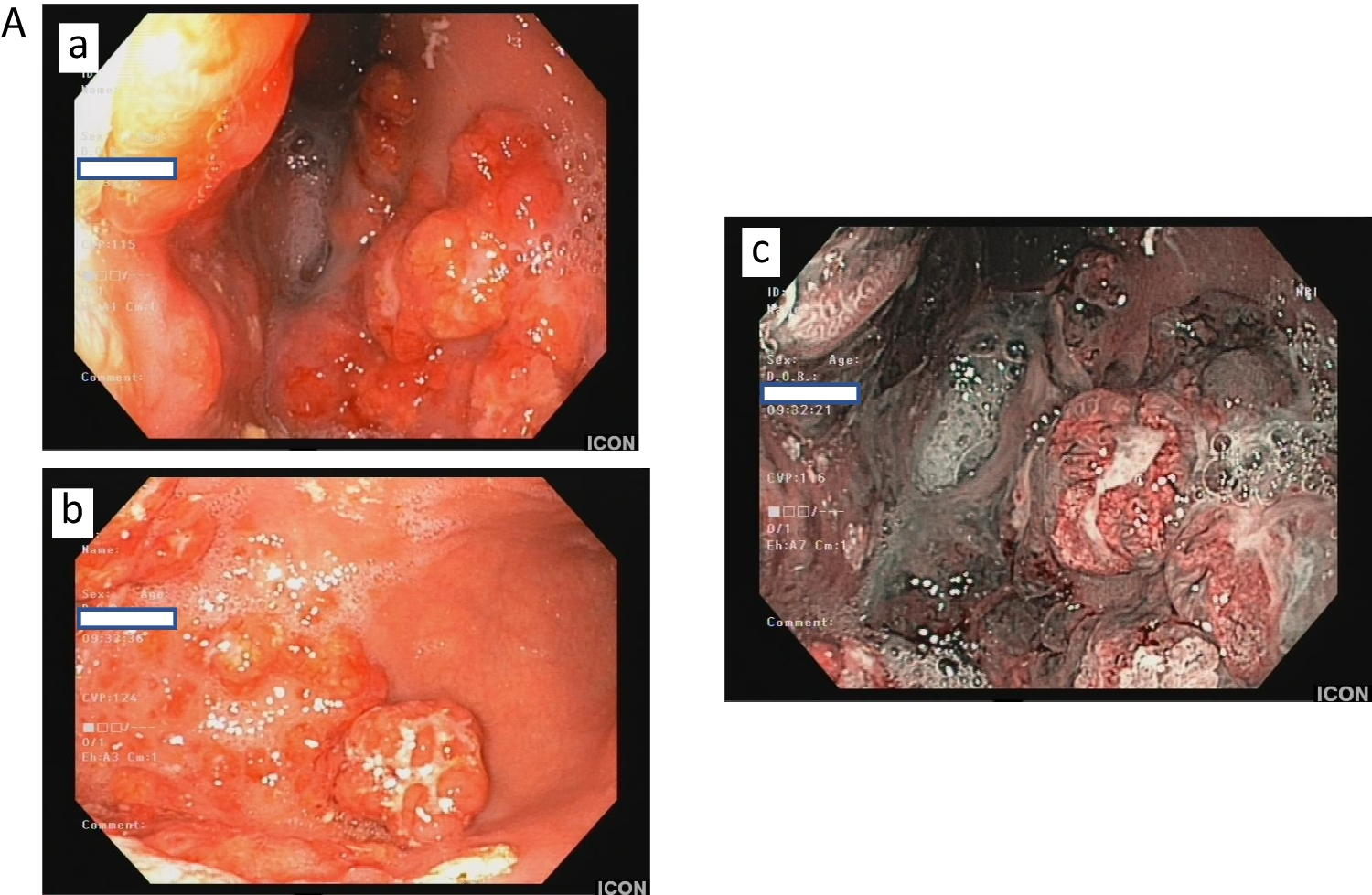 When rare diseases crisscross within the same patient: von Hippel-Lindau and type 1 gastric neuroendocrine tumor