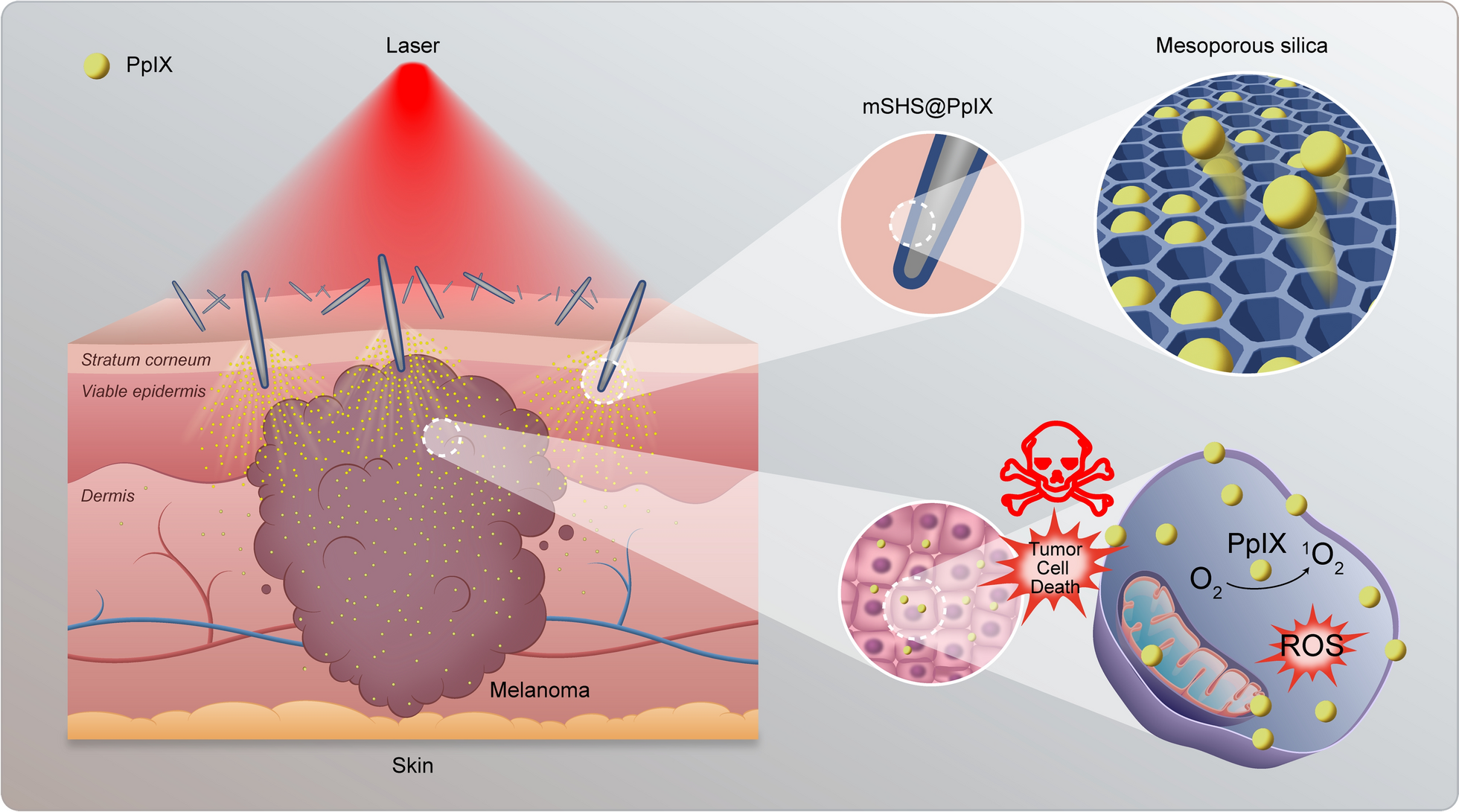 Mesoporous silica coated spicules for photodynamic therapy of metastatic melanoma