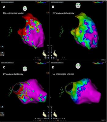 Signal-averaged electrocardiography as a noninvasive tool for evaluating the ventricular substrate in patients with nonischemic cardiomyopathy: reassessment of an old tool