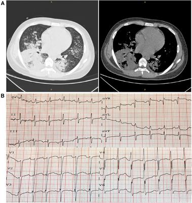 A Case Report of Mycoplasma pneumoniae-induced fulminant myocarditis in a 15-year-old male leading to cardiogenic shock and electrical storm