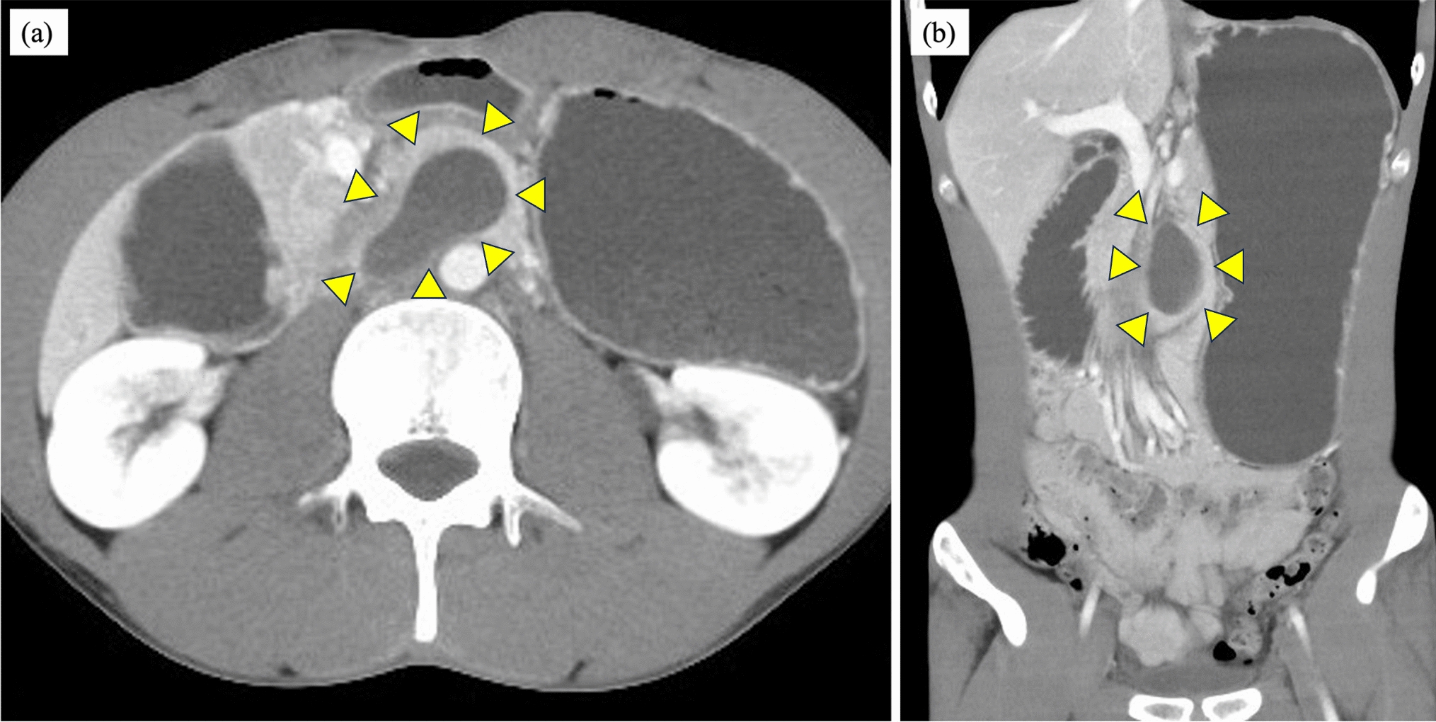 Symptomatic duodenal intramural hematoma caused by weight training: a report of two cases