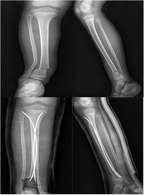 Elastic stable intramedullary nail combined with Kirschner wire (E-K) technique for treating pediatric distal tibial diaphyseal metaphyseal junction (DTDMJ) fractures