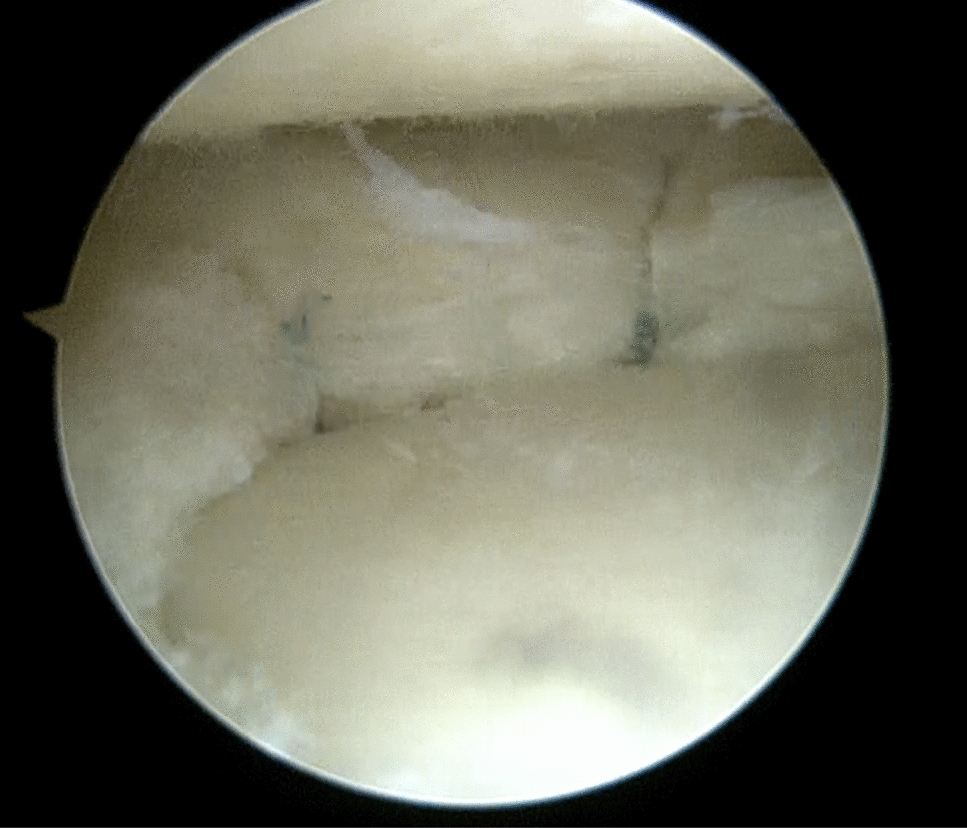 The Impact of Bone Marrow Venting Augmentation on Knee Functions in the Repair of Vertical/Longitudinal Meniscus Tears: A Triple Comparison