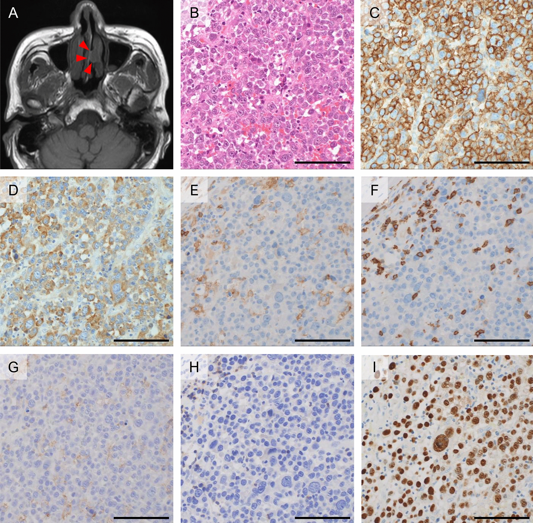 Spontaneous regression of multiple solitary plasmacytoma harboring Epstein–Barr virus: a case report and literature review
