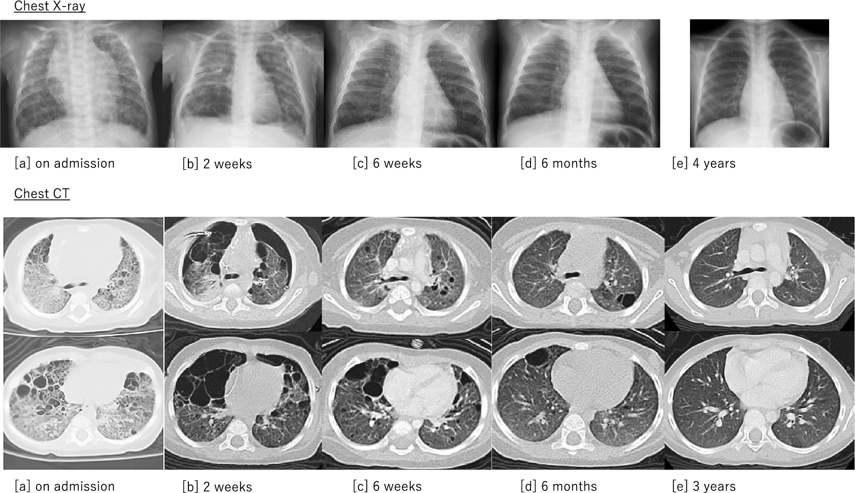 Honeycomb lung appearance accompanied by pediatric Langerhans cell histiocytosis: changes in imaging findings following chemotherapy