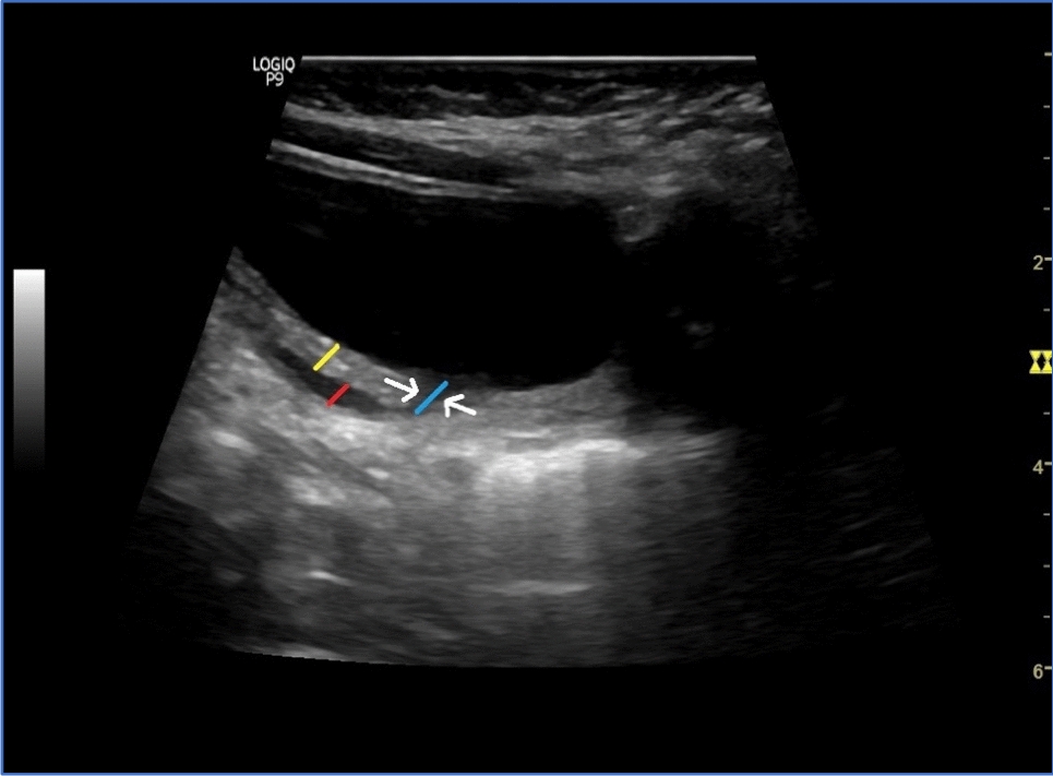 Ultrasound-based predictive indicators for treatment outcomes in pediatric vesicoureteral reflux