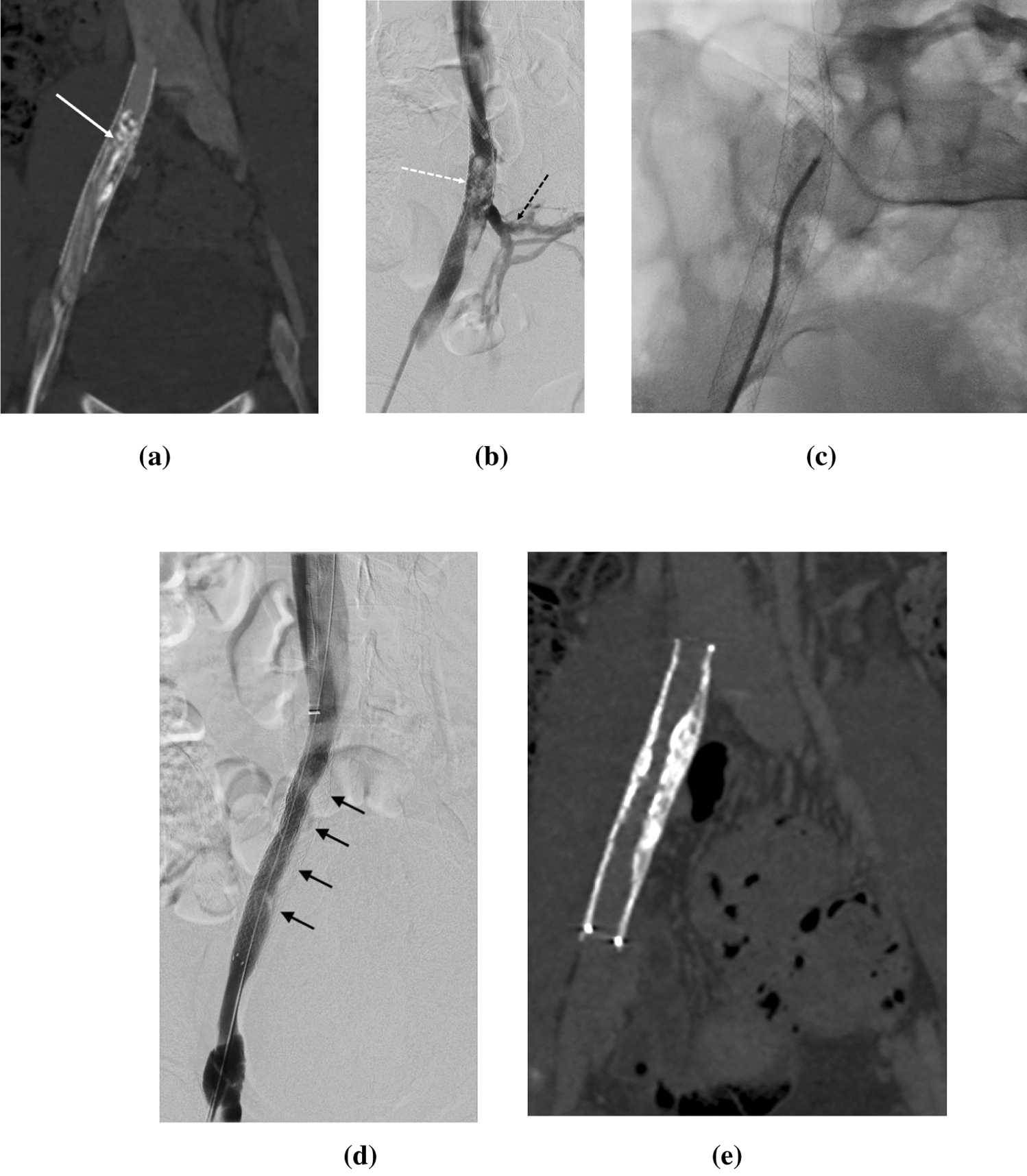 Treatment of Chronic Calcified Endostent Venous Occlusion by Intravascular Lithotripsy