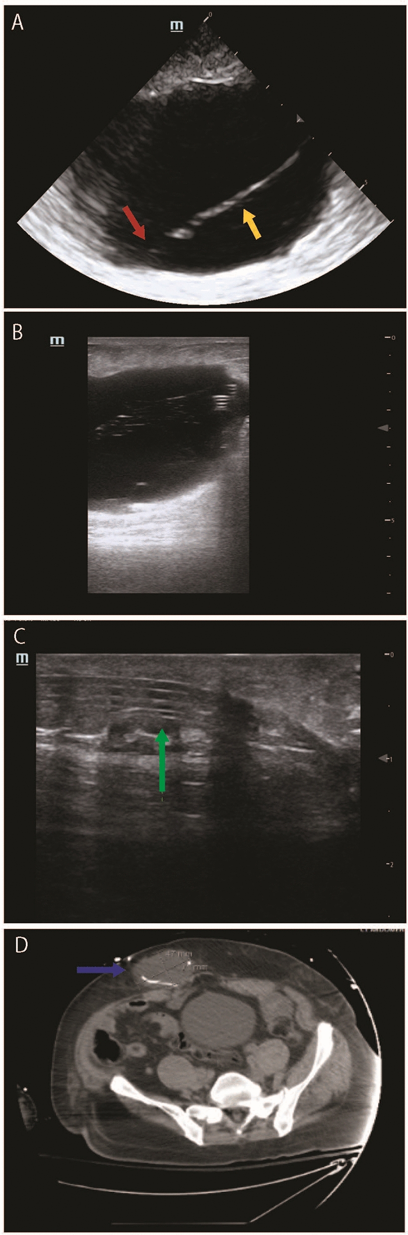 Point-of-Care Ultrasound to Rapidly Detect a Malpositioned Ventriculoperitoneal Shunt