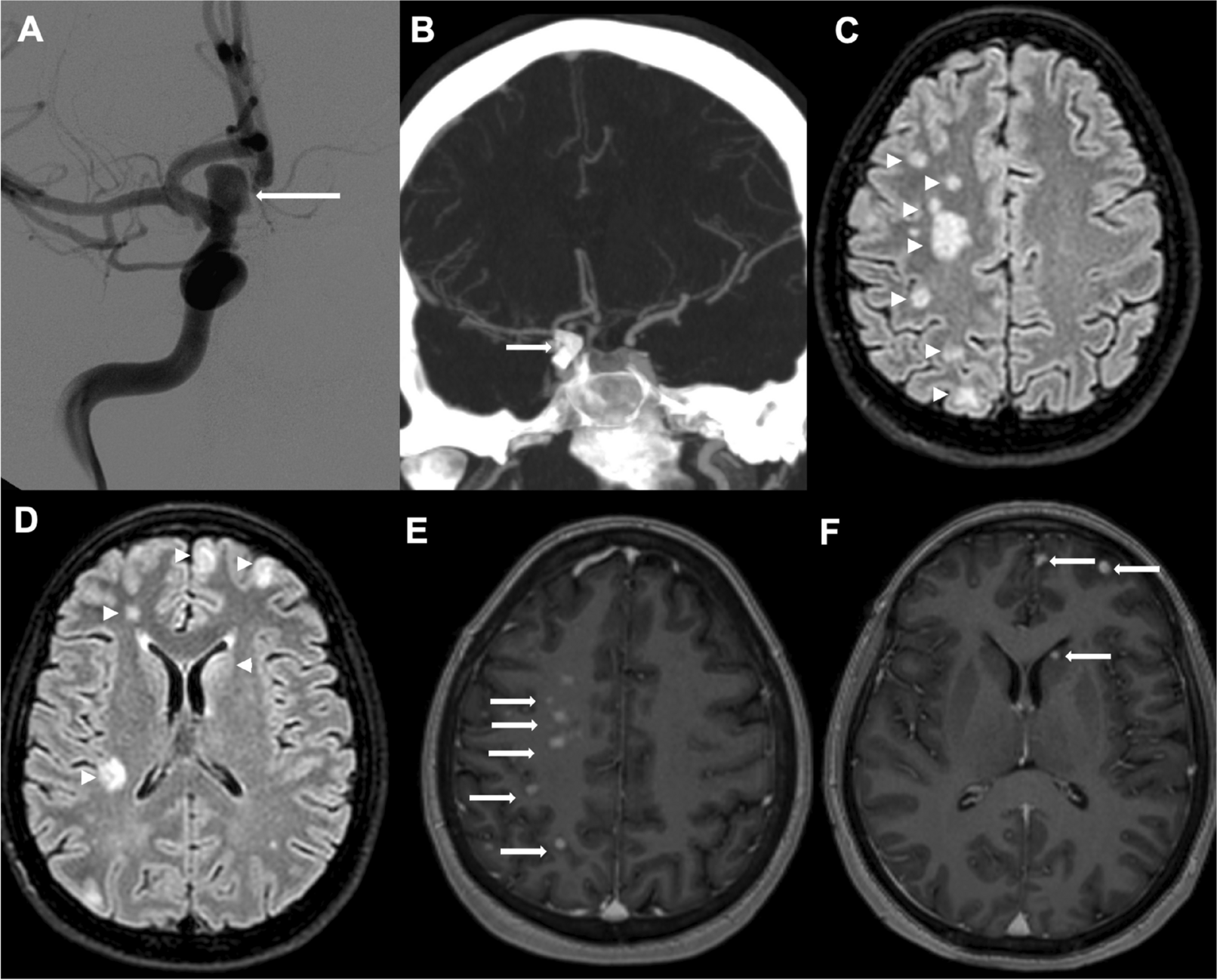 Bilateral delayed non-ischemic enhancing brain lesions after treatment with flow-diverter