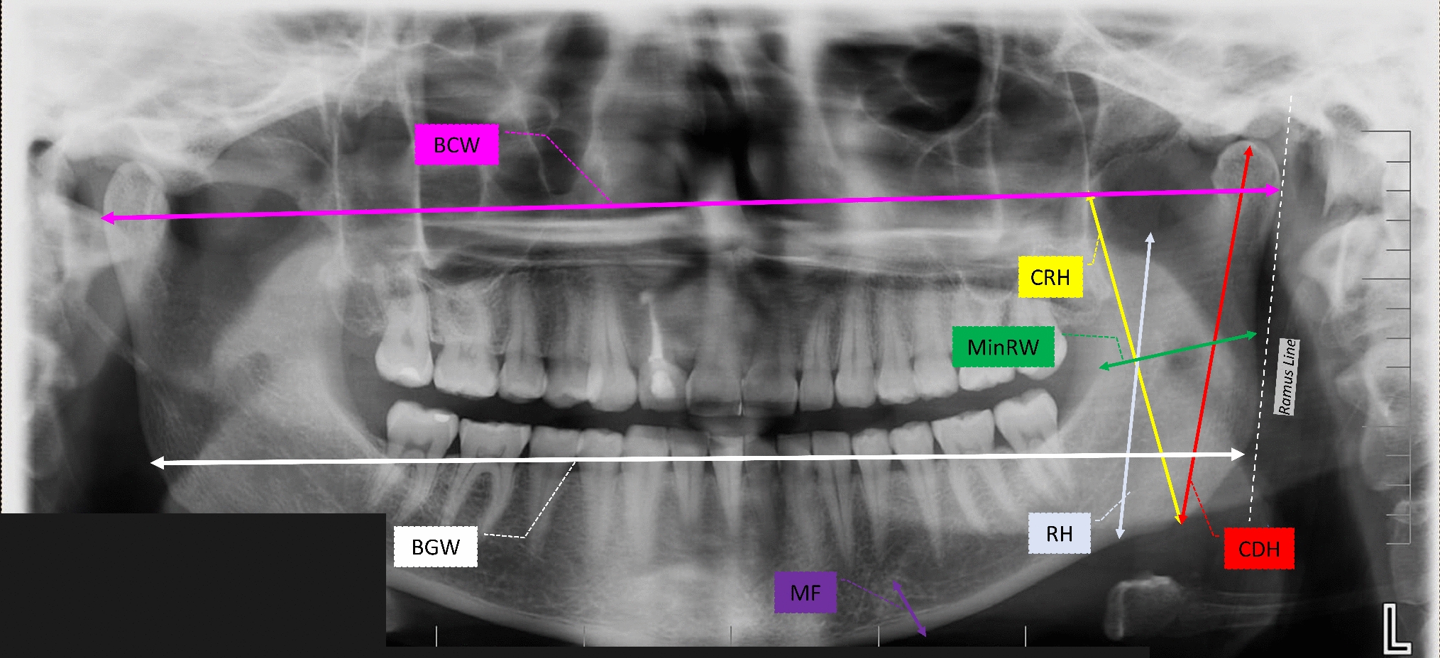 Comparison of mandibular morphometric parameters in digital panoramic radiography in gender determination using machine learning