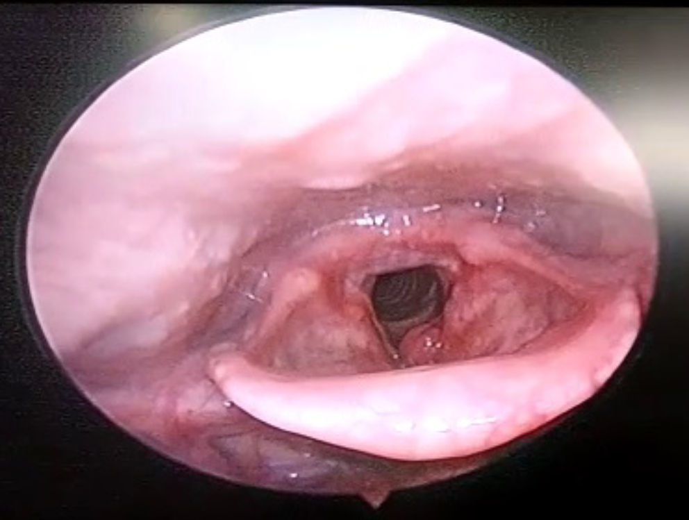 A rare case of extragastrointestinal stromal tumor of vocal cord - case report