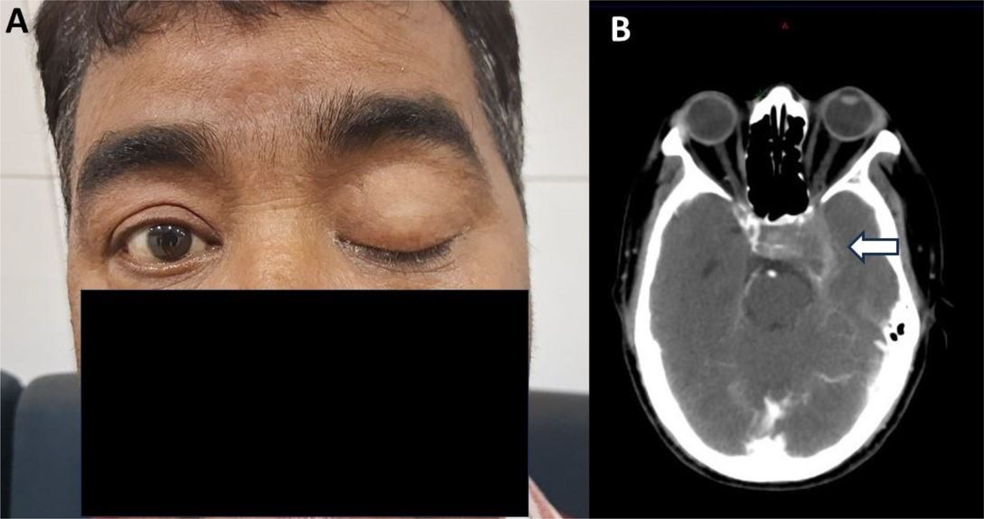 Cavernous Sinus Metastasis in Patients of Head & Neck Squamous Cell Carcinoma: A Series of Five Rare Instances and Review of Literature