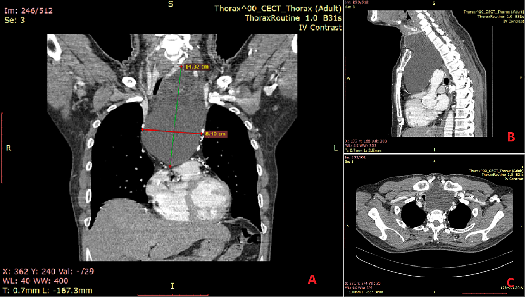 Excision of Giant Cervicomediastinal Parathyroid Cyst: Case Report and Literature Review
