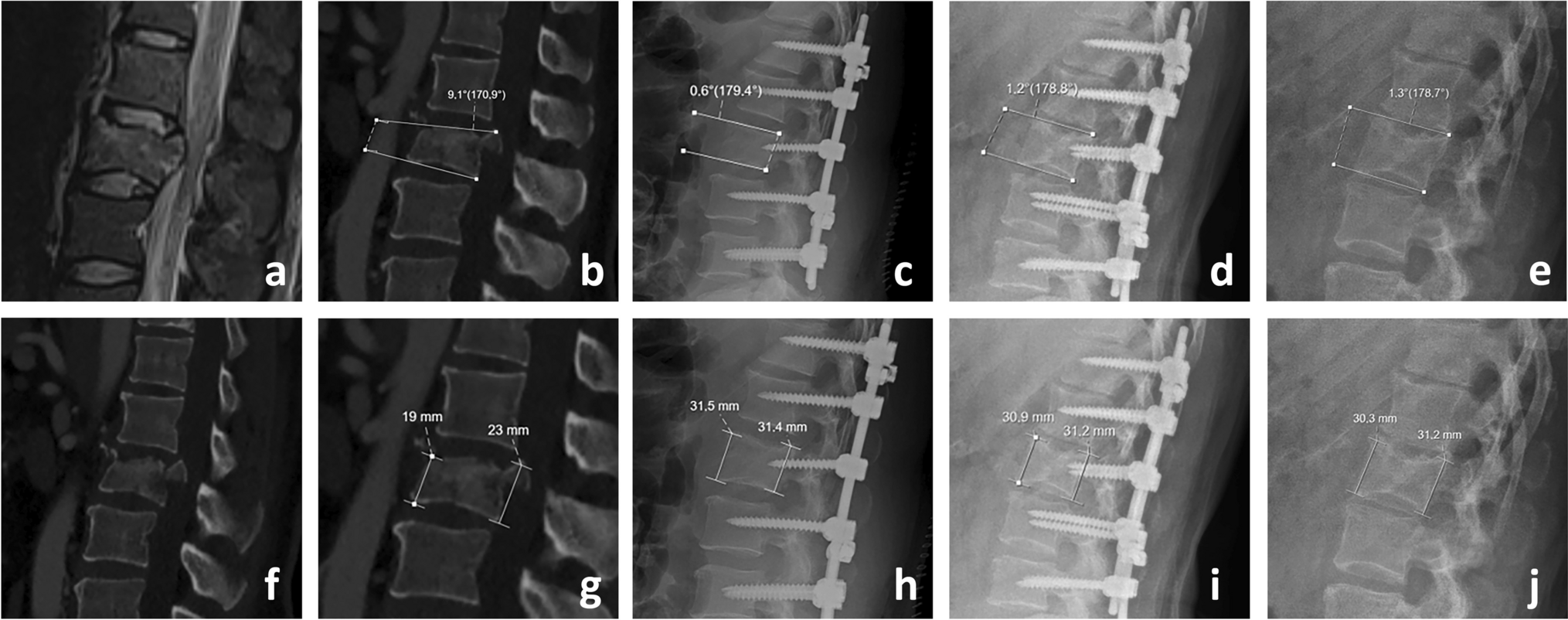 Should the level of the posterior instrumentation combined with the intermediate screw be a short segment or a long segment in thoracolumbar fractures with fusion to the fractured segment?