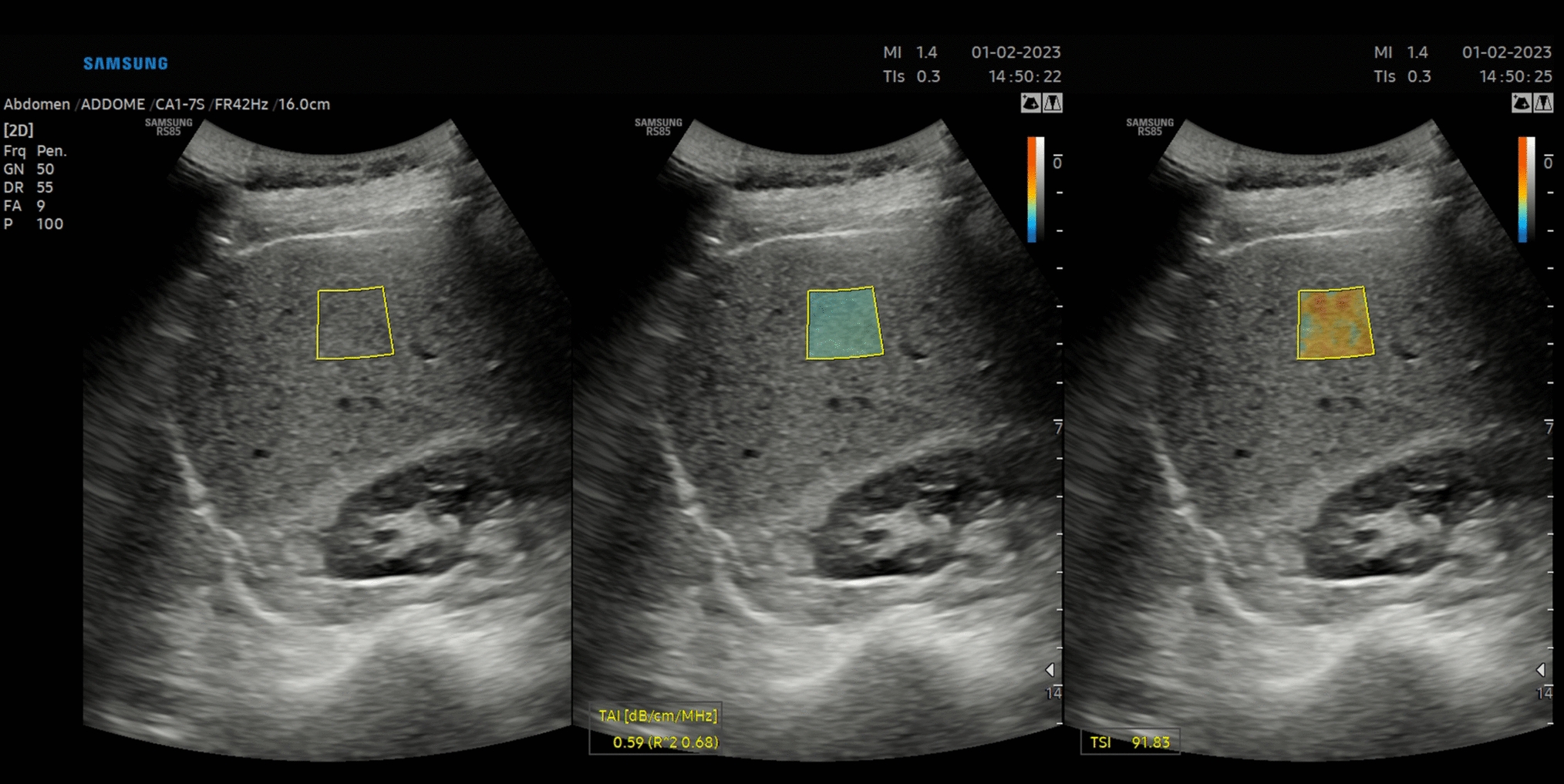 Quantitative ultrasound (QUS) in the evaluation of liver steatosis: data reliability in different respiratory phases and body positions