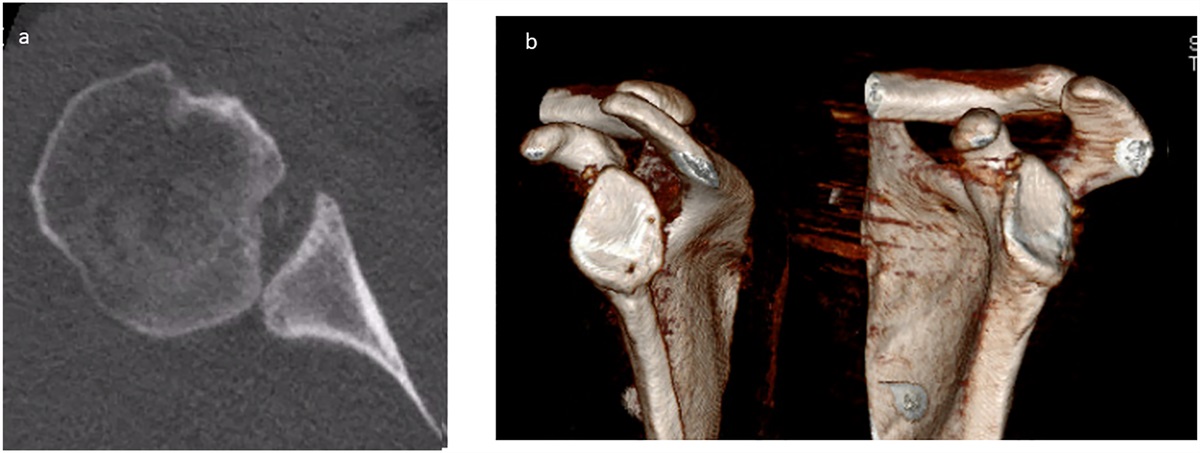 Management of Bone Loss in Posterior Glenohumeral Shoulder Instability: Current Concepts