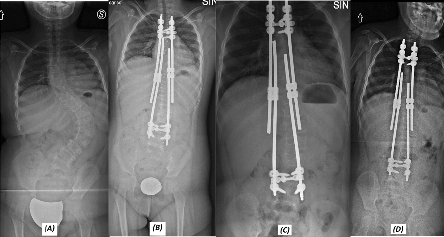 Scoliosis and rare diseases: our experience with the Prader–Willi syndrome