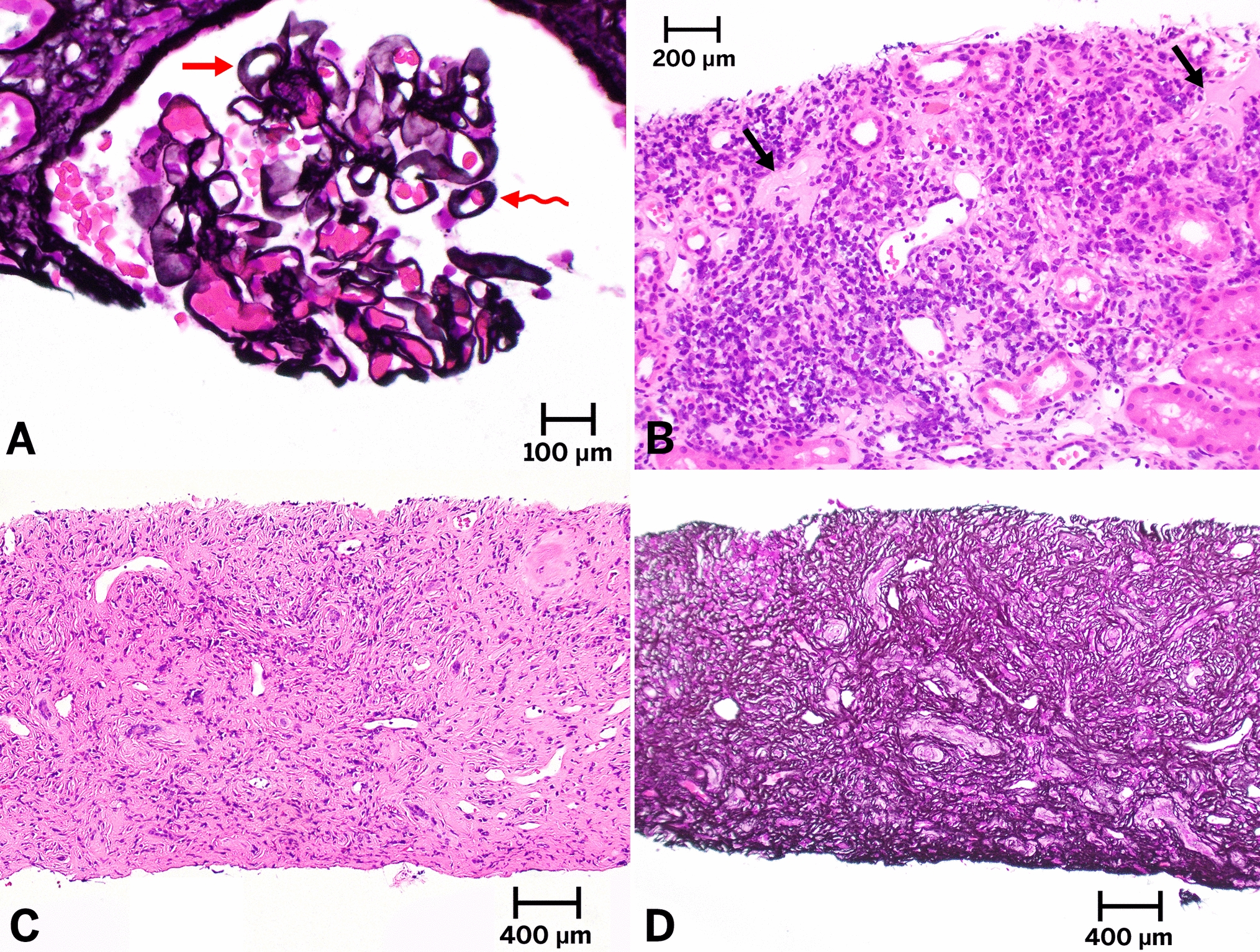 ALECT2 amyloidosis with concurrent IgG4-related interstitial nephritis, membranous nephropathy and diabetic kidney disease: a case report and literature review