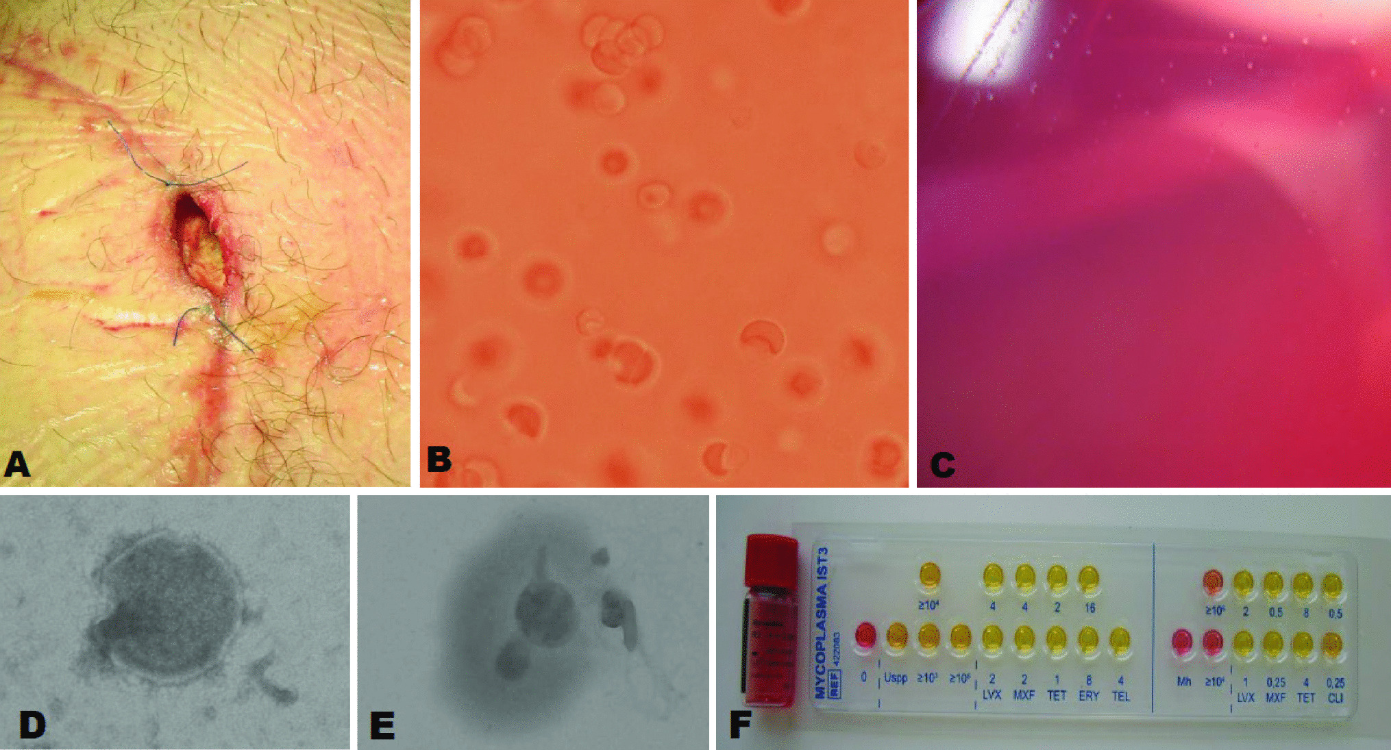 A rare case of postoperative Metamycoplasma hominis surgical site infection in a patient after bilateral lung transplantation