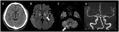 Case report: Consecutive hyperbaric oxygen therapy for delayed post-hypoxic leukoencephalopathy resulting from CHANTER syndrome caused by opioid intoxication
