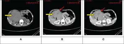 Ewing sarcoma of the pancreas: a pediatric case report and narrative literature review