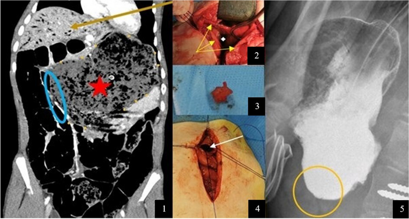 Gastric pneumatosis and aeroportia in gastroparesis with recurring functional pyloric stenosis