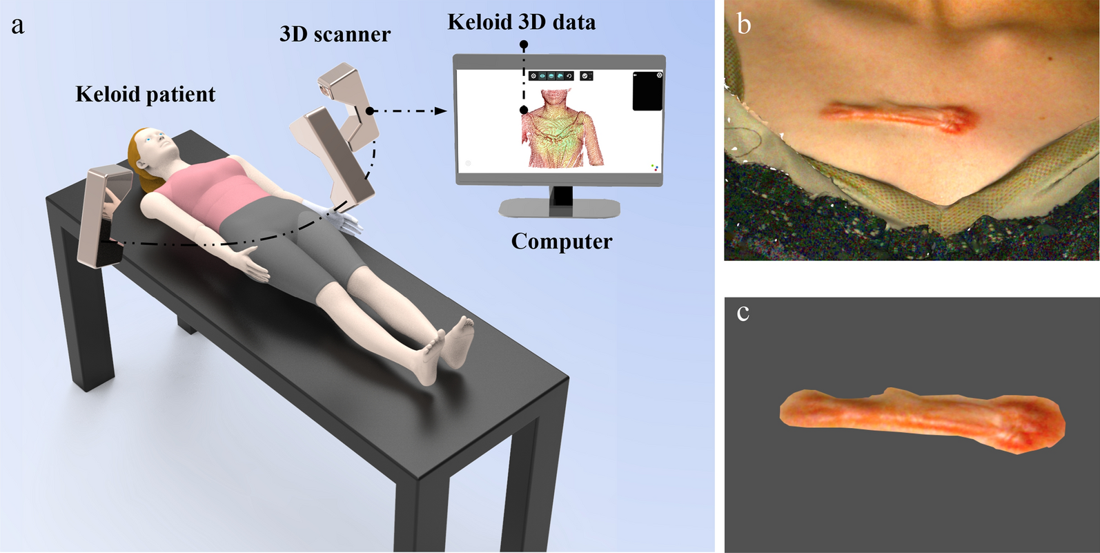 Application of high-precision 3D scanner in keloids evaluation to improve patients’ compliance: a questionnaire-based study