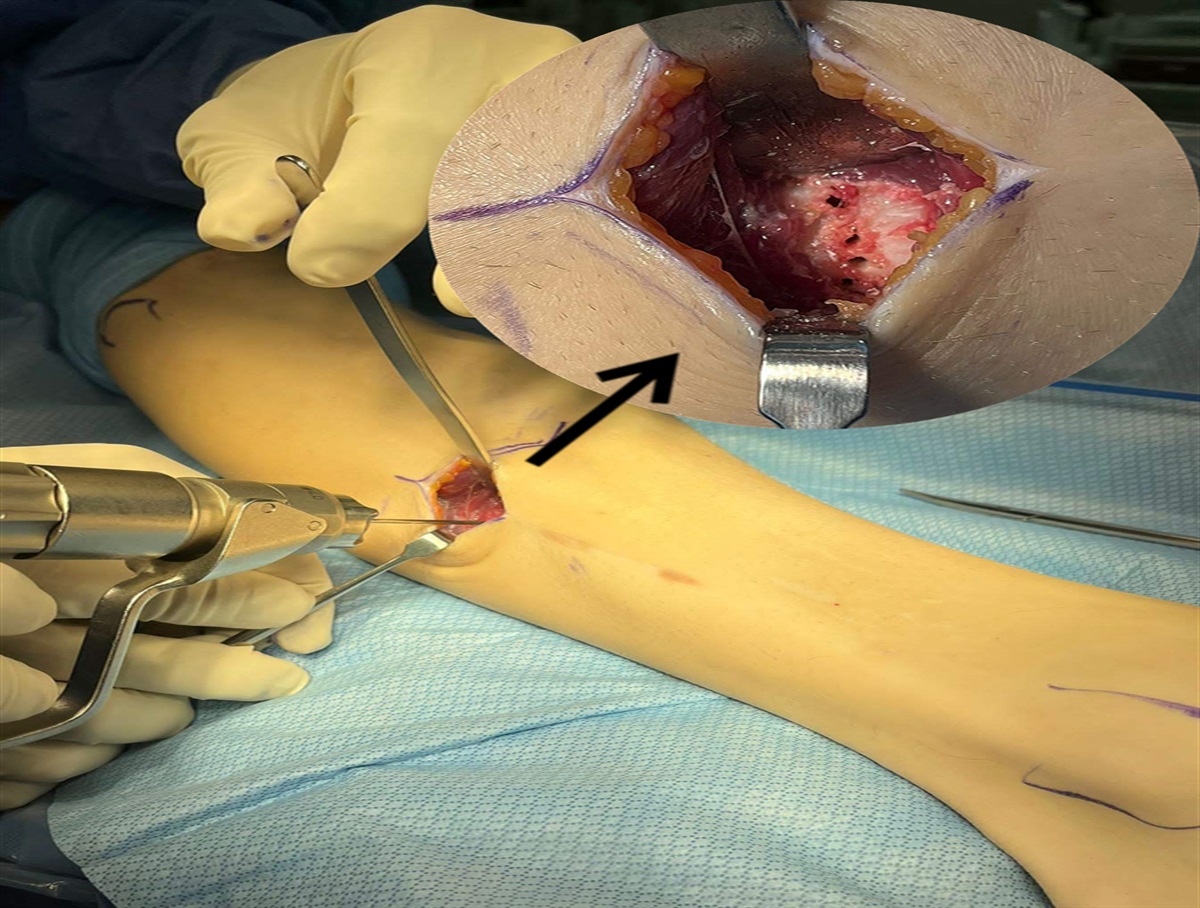 Prevention of Complications During Fibular Osteotomy